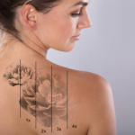 saline tattoo removal Melbourne