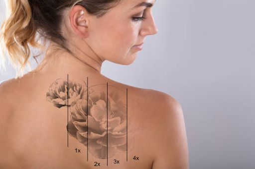 saline tattoo removal Melbourne