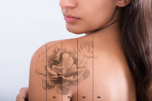 tattoo removal with saline in Melbourne